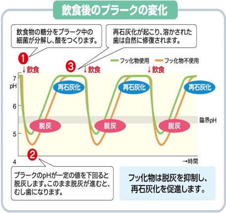 むし歯治療