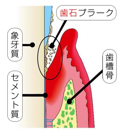 歯周病治療