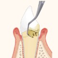 歯周病治療